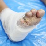 Diabetes Foot & Wound Care